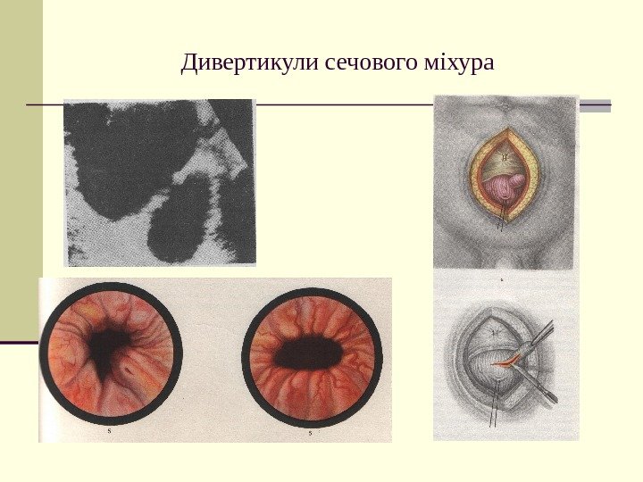   Дивертикули сечового міхура 